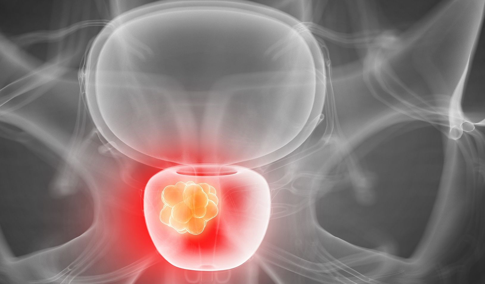 prosztatanagyobbodás tünetei a prostatitis tinktúra kezelése